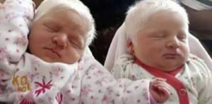 albino twins